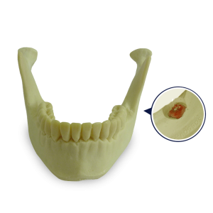 MANDÍBULA COM DENTE 38 INCLUSO - cód. 4402-02T